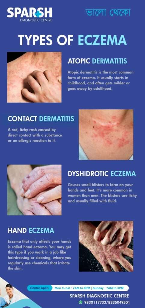Eczema And Atopic Dermatitis Rashes Causes Symptoms Atopic Vs Contact Eczema And Atopic Dermatitis Rashes Causes Symptoms Atopic Vs Contact
