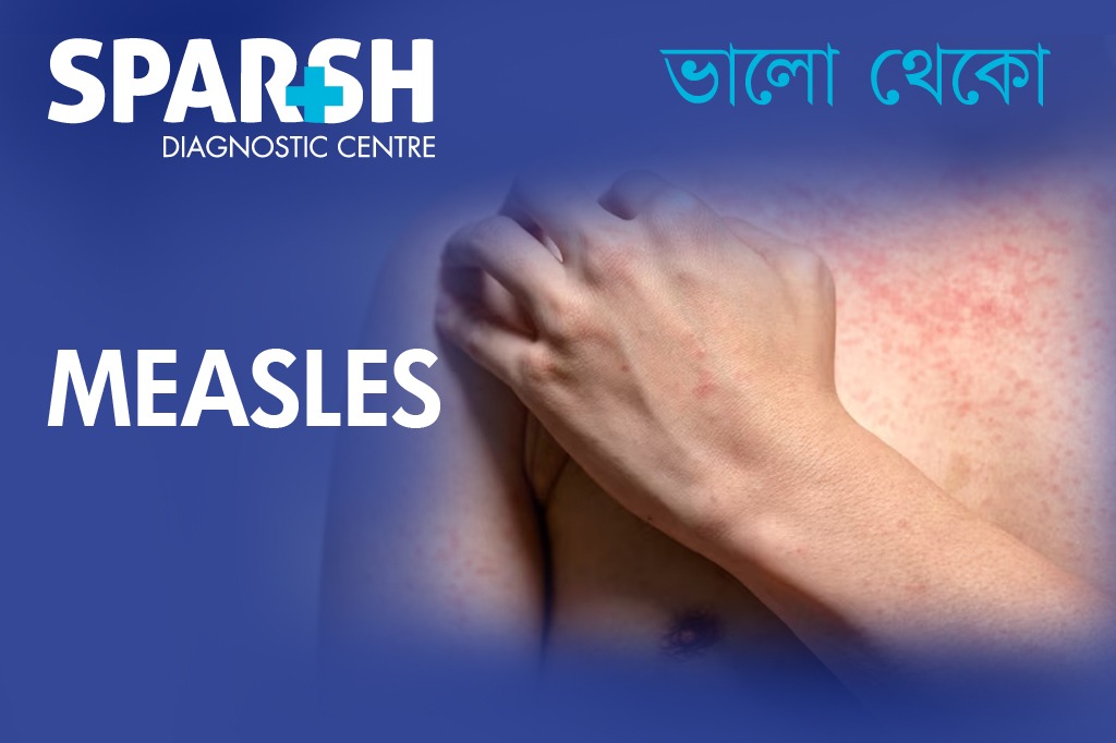 Measles. Measles Treatment in Kolkata. Doctor for Measles. Best Diagnostic Centre in Kolkata.