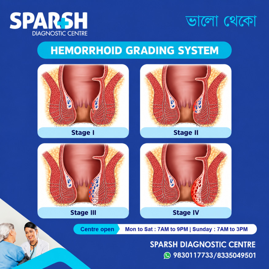 Hemorrhoids Grades