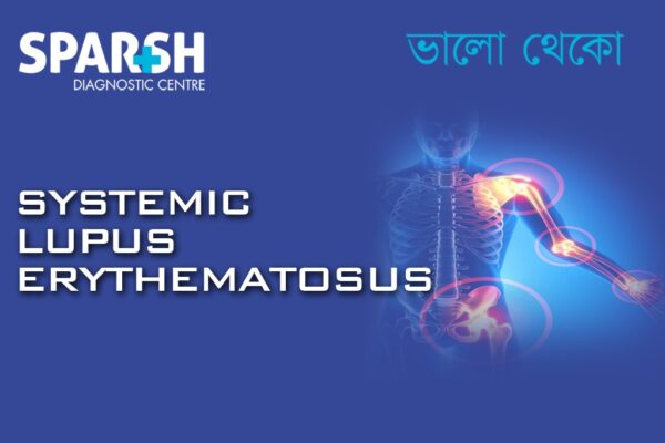 Sle 400 Understanding Systemic Lupus Erythematosus (SLE) - Sparsh Diagnostic Center