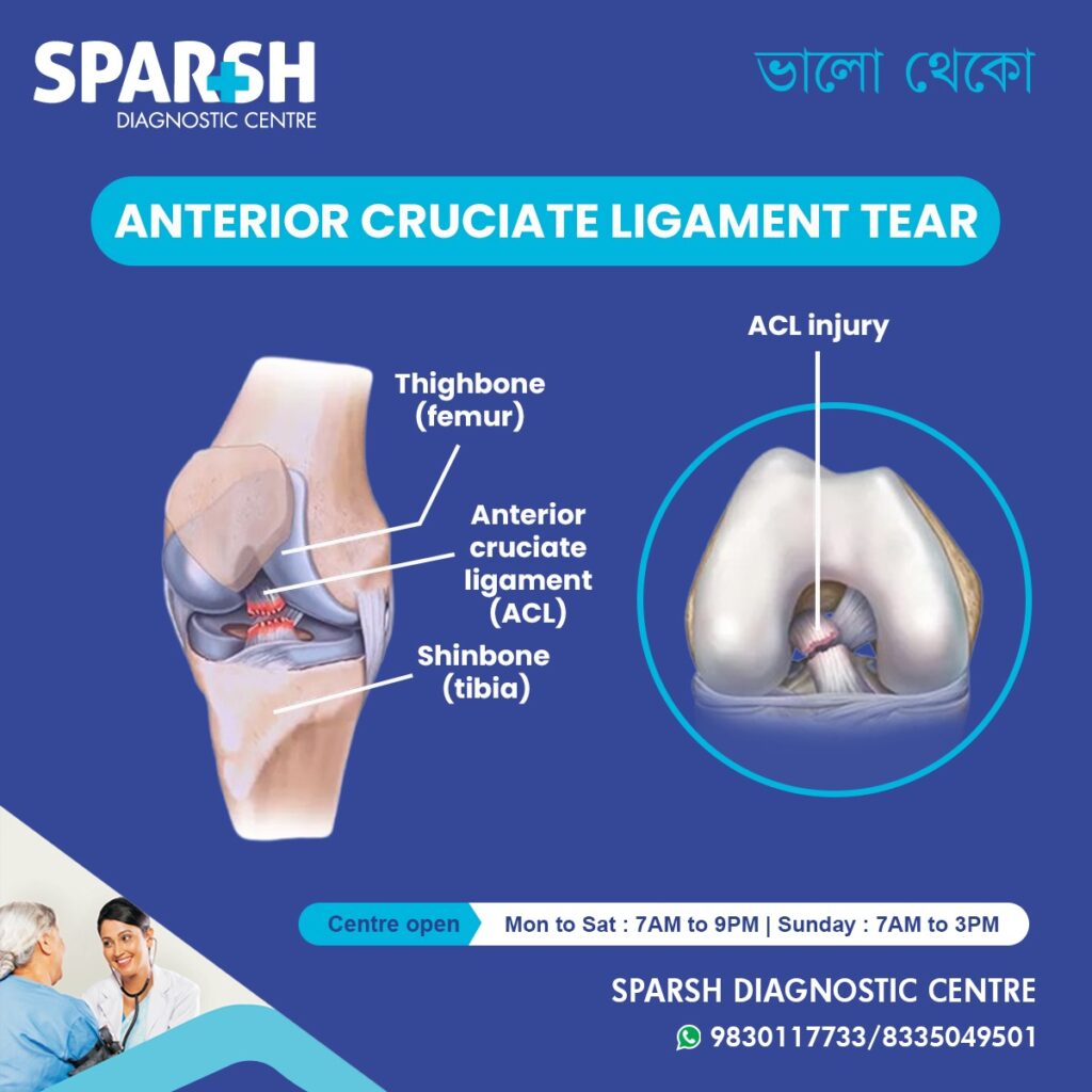 ACL Tear - Sparsh Diagnostic Center