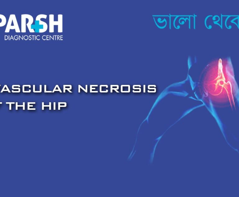 Avascular Necrosis of the Hip