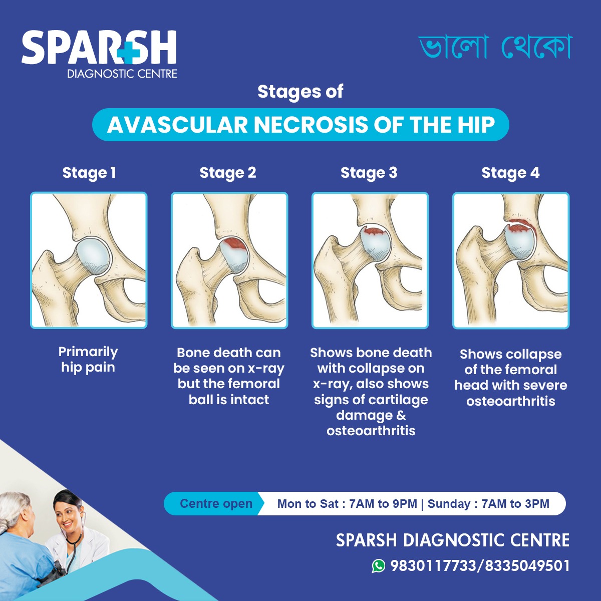 Avascular Necrosis of the Hip