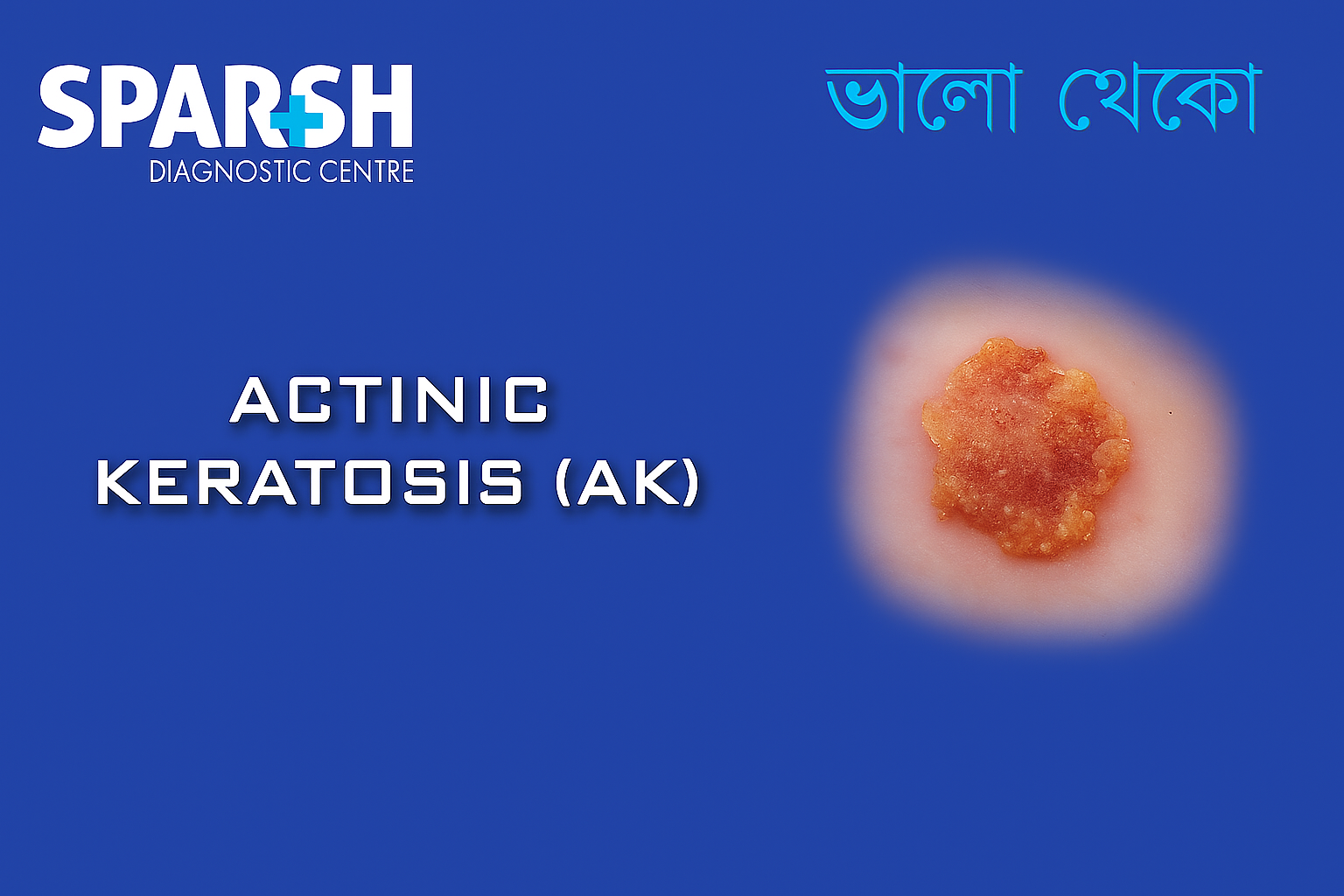 Actinic Keratosis AK. Blood testing service.