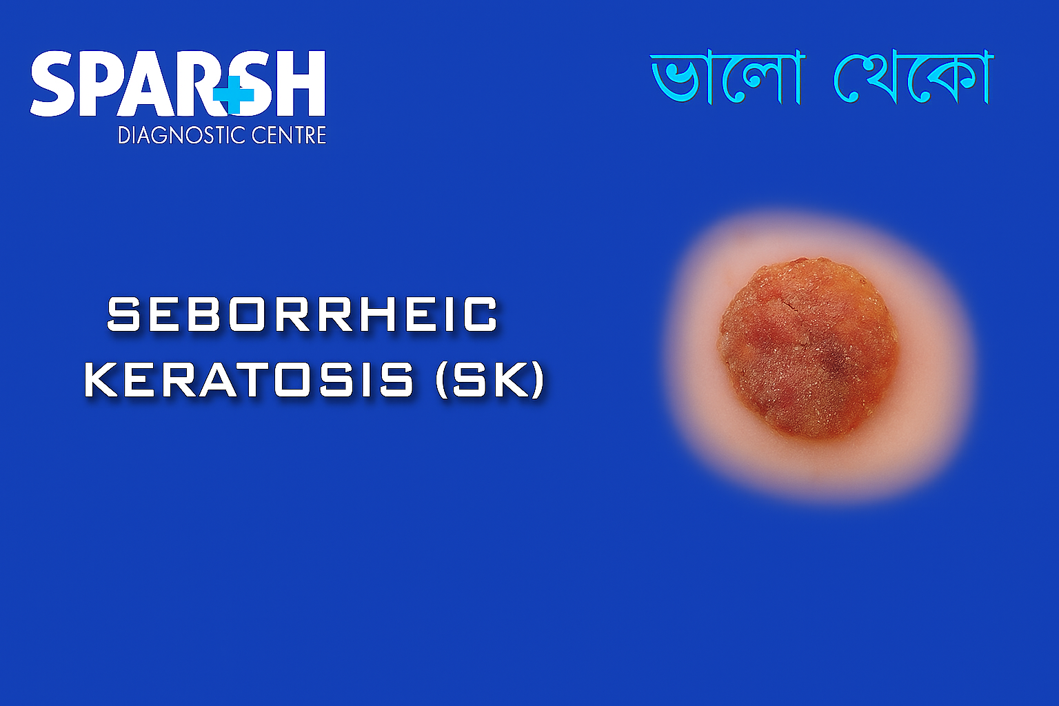 Seborrheic Keratosis. Blood testing service.