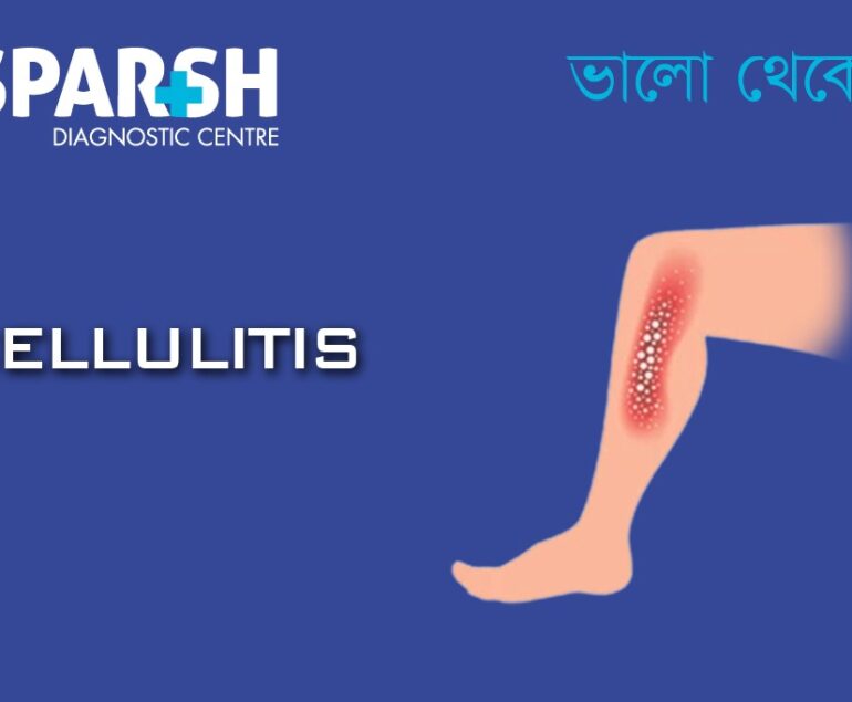 Cellulitis