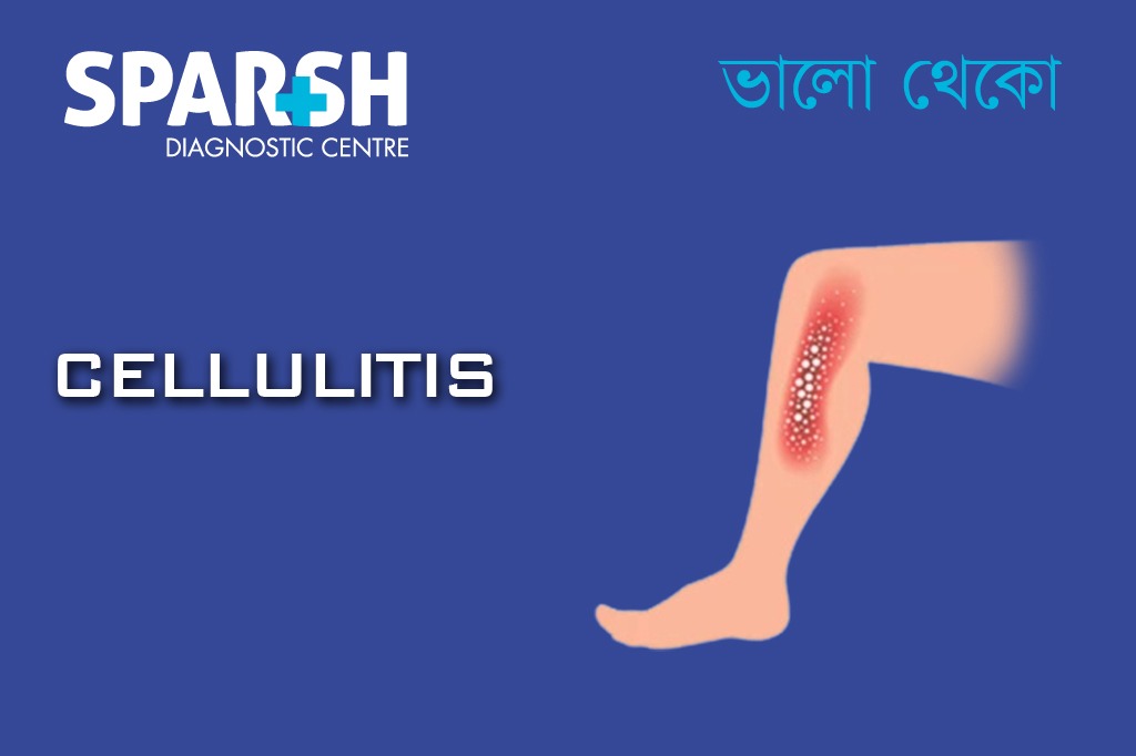 Cellulitis