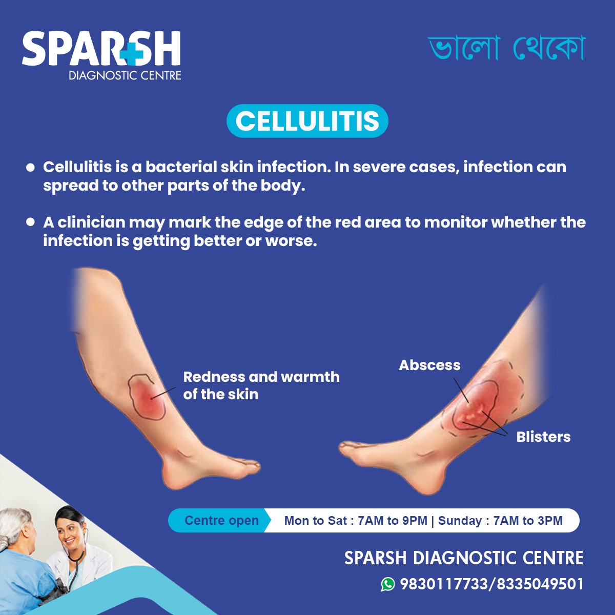 Cellulitis