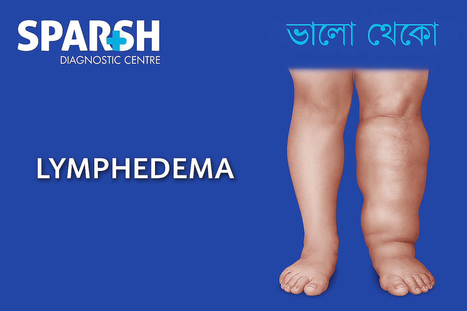 Lymphedema