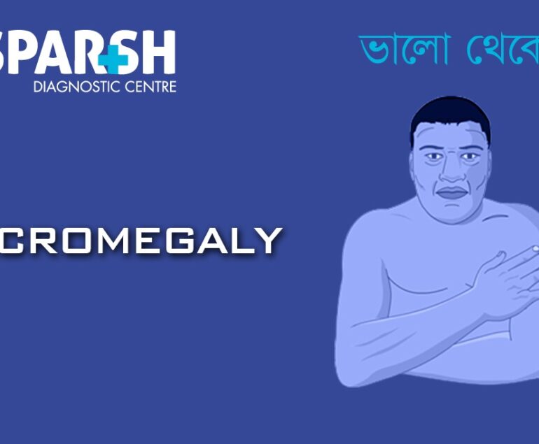 Acromegaly