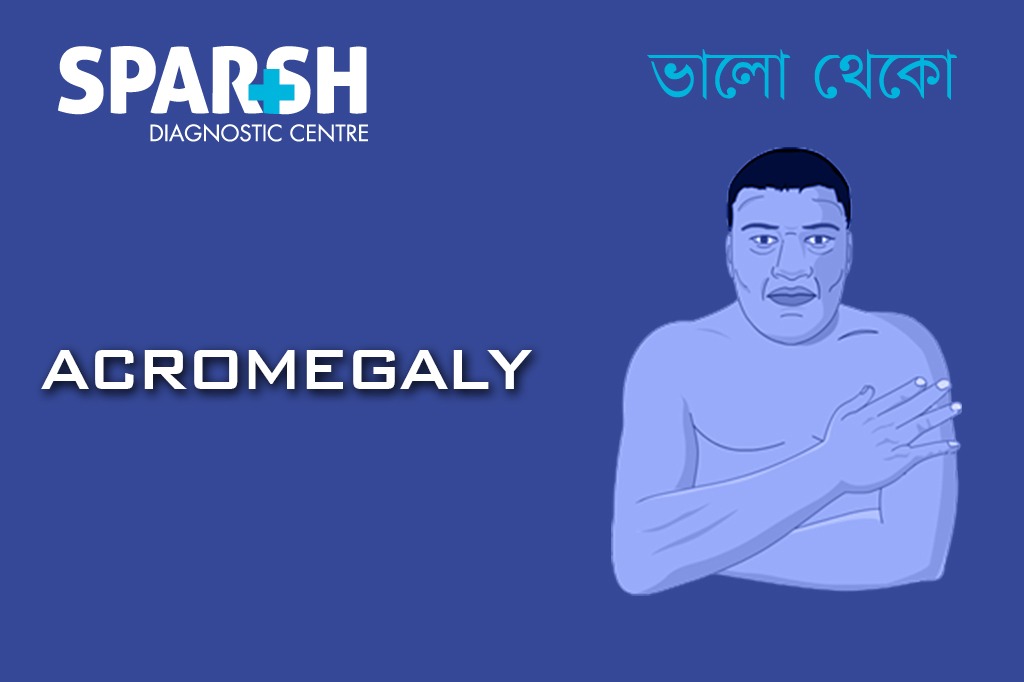 Acromegaly