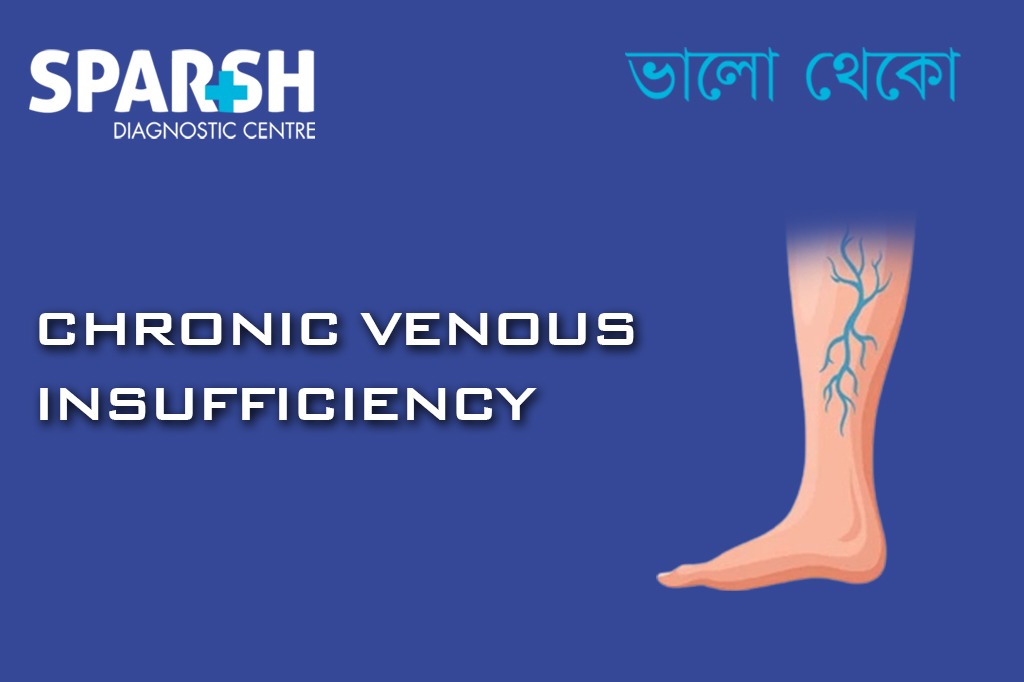 Chronic Venous Insufficiency