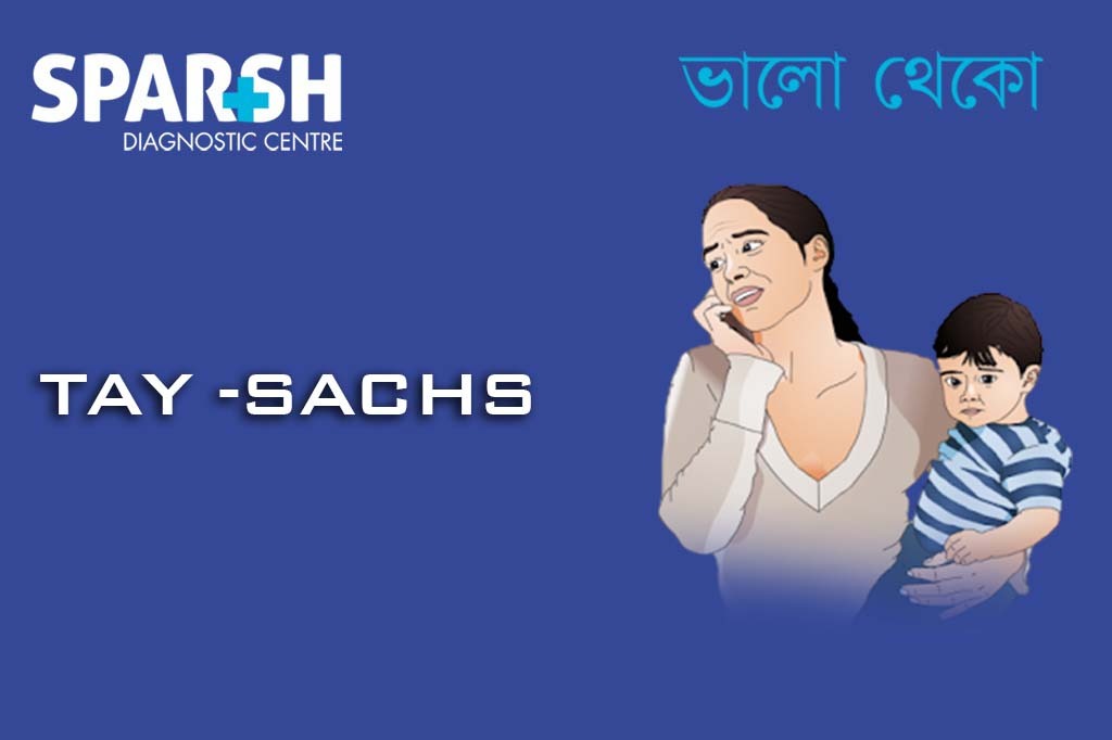 Tay Sachs Disease
