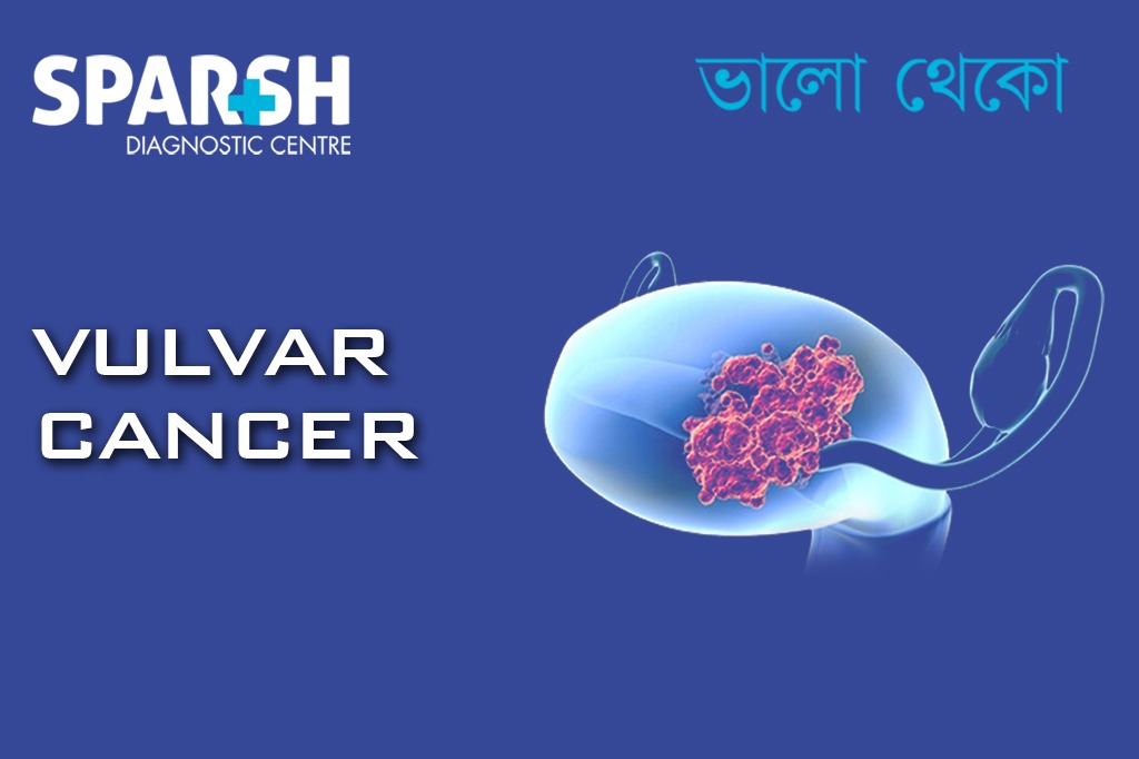 Vulvar Cancer