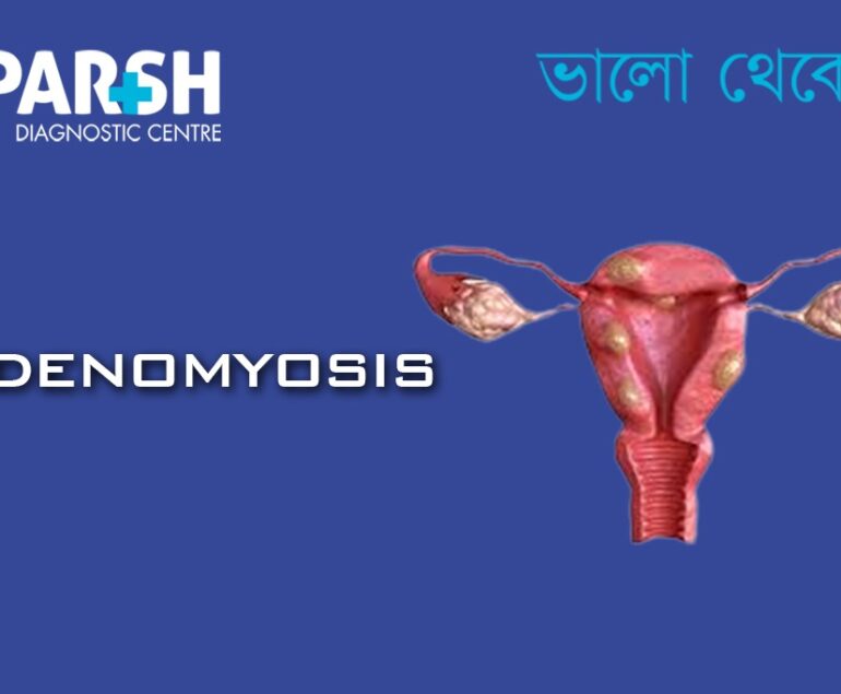 Adenomyosis