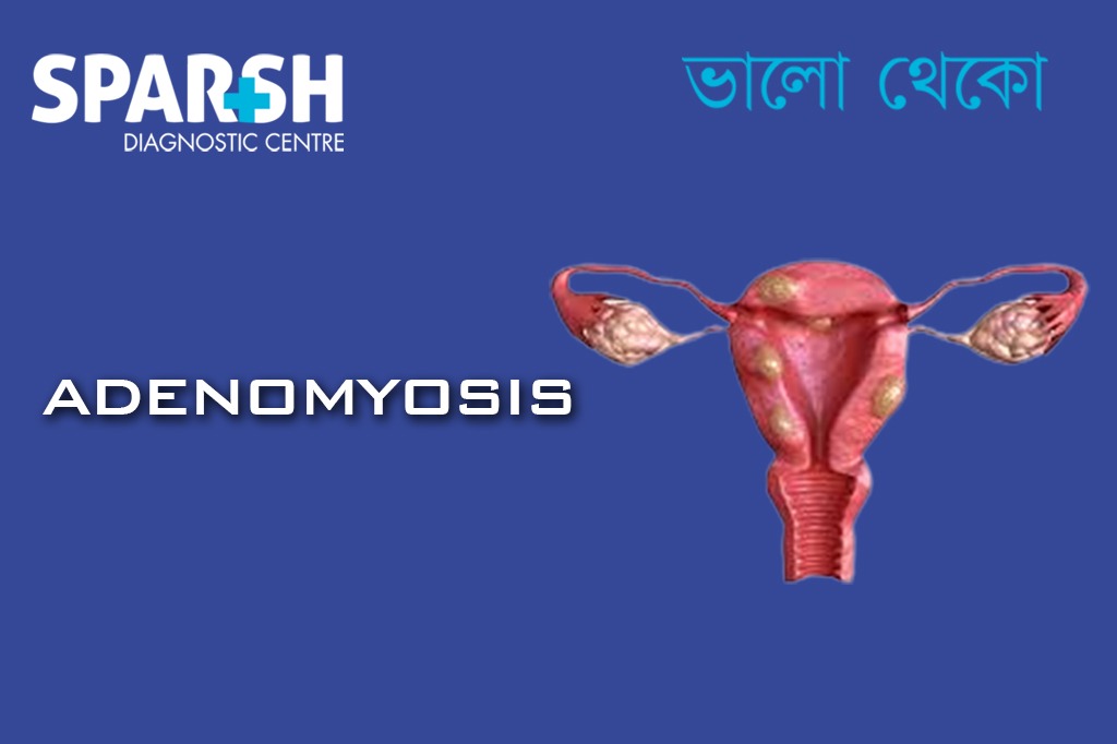 Adenomyosis