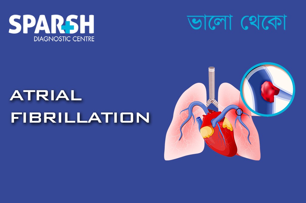 Atrial Fibrillation (AFib)