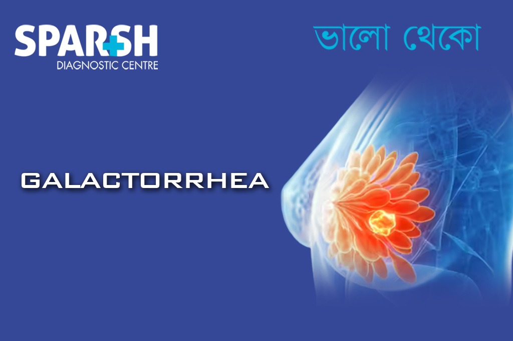 Galactorrhea