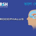 Hydrocephalus CP
