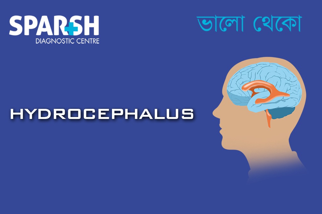 Hydrocephalus CP