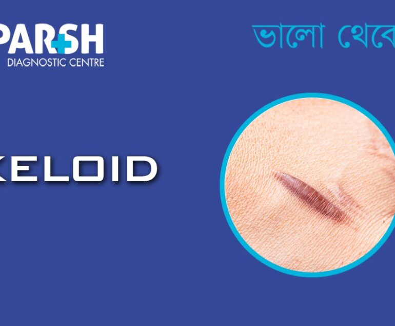 Keloid