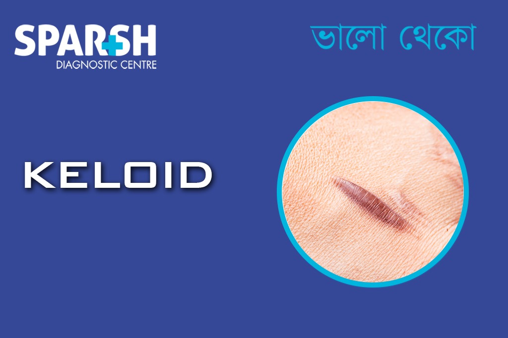 Keloid
