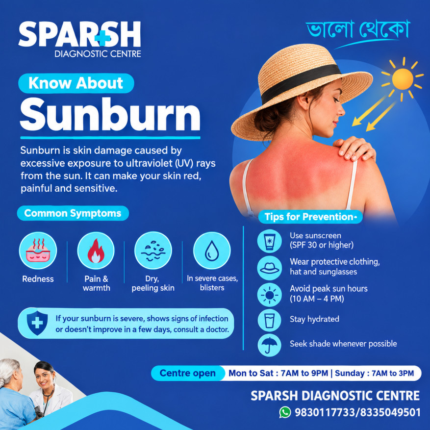 Sunburn