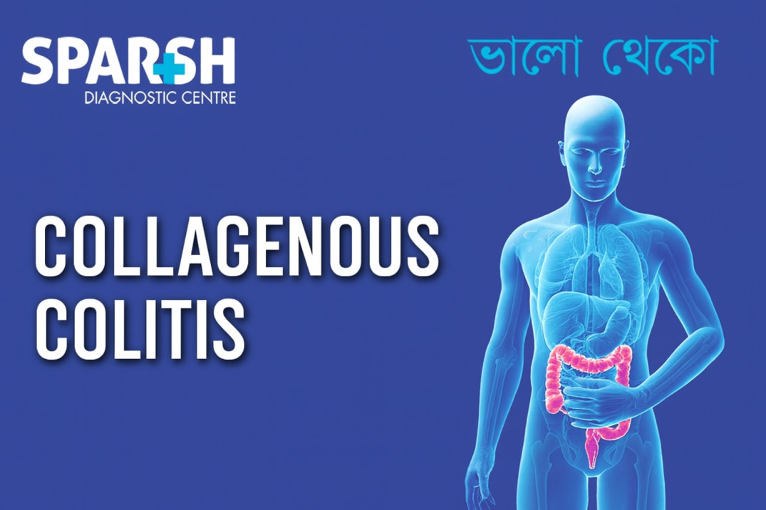 Collagenous Colitis