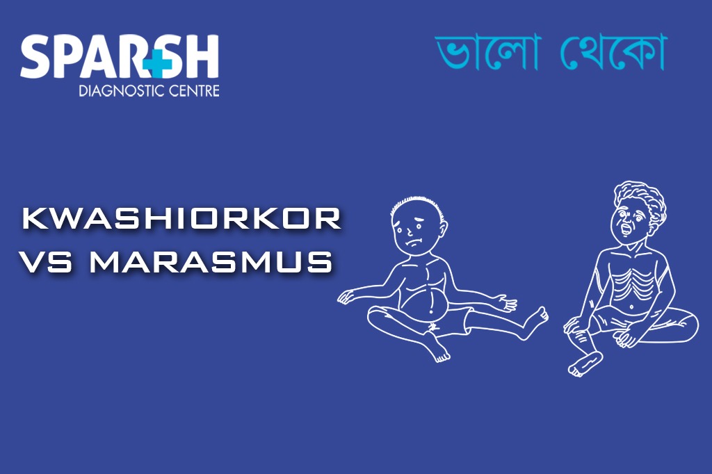 Kwashiorkor And Marasmus
