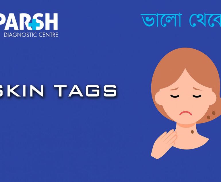 Skin Tags