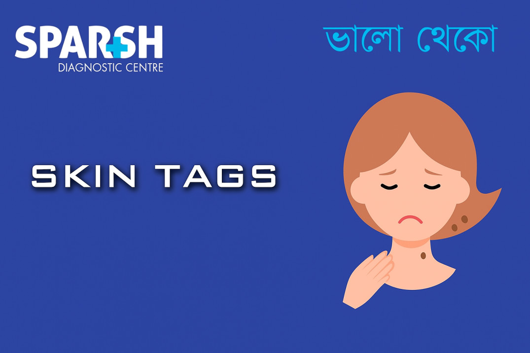Skin Tags
