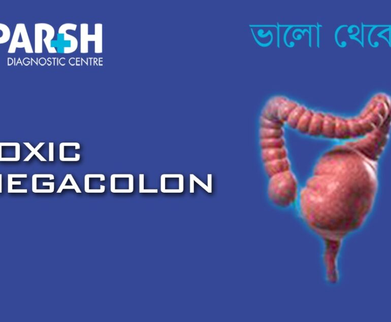 Toxic Megacolon