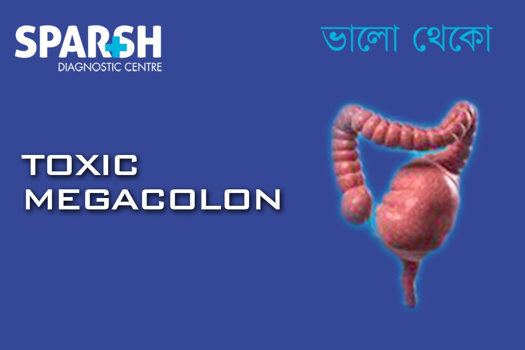 Toxic Megacolon