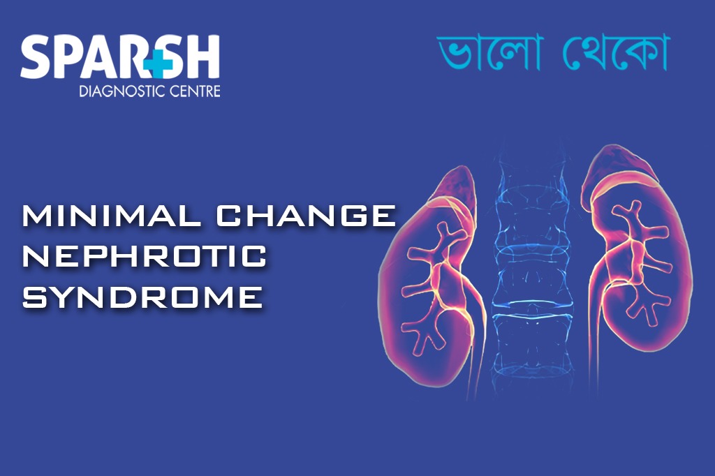Minimal Change Nephrotic Syndrome