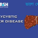 Polycystic Liver Disease CP