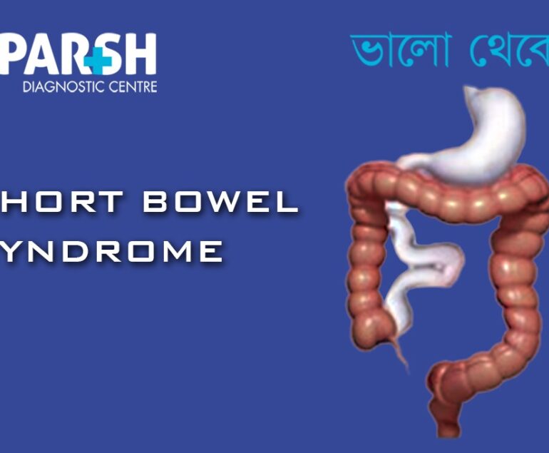 Short Bowel Syndrome