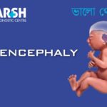 Anencephaly