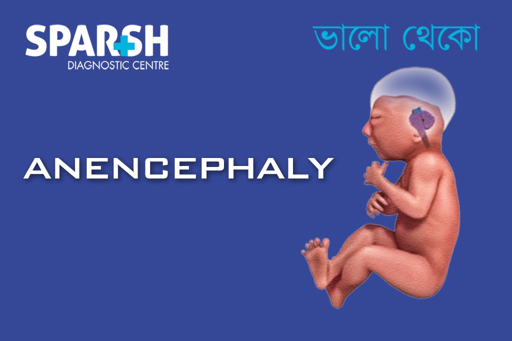 Anencephaly