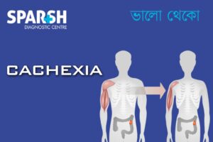 Cachexia: Causes, Symptoms, Diagnosis, and Treatment Explained - Sparsh ...