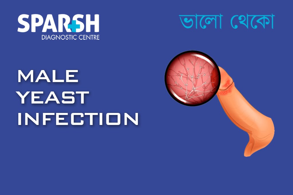 Male Yeast Infection