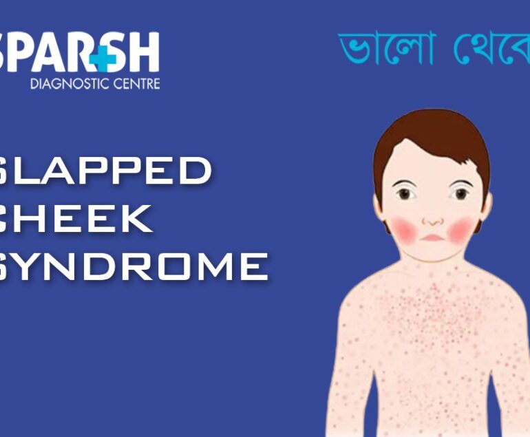 Slapped Cheek Syndrome CP