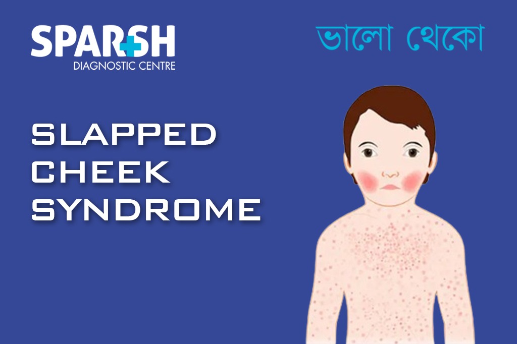 Slapped Cheek Syndrome CP