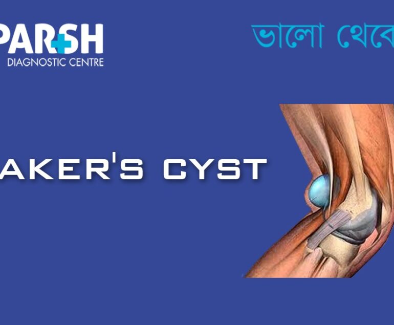 Bakers Cyst CP
