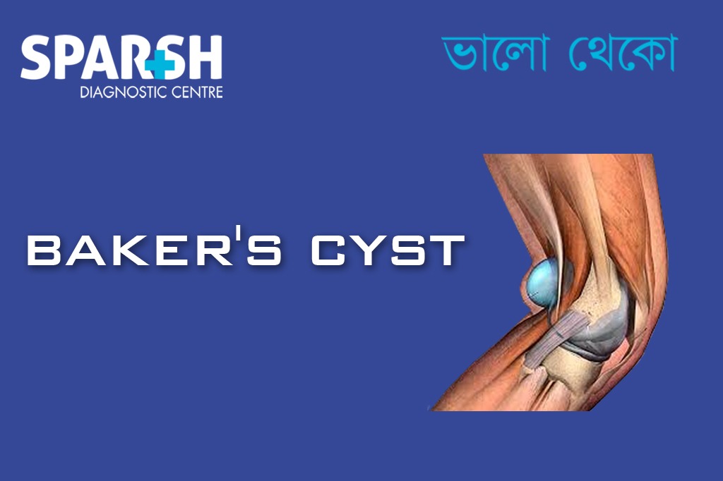 Bakers Cyst CP