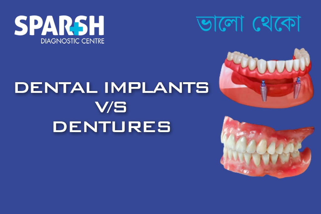 Dental Implants Vs Dentures CP