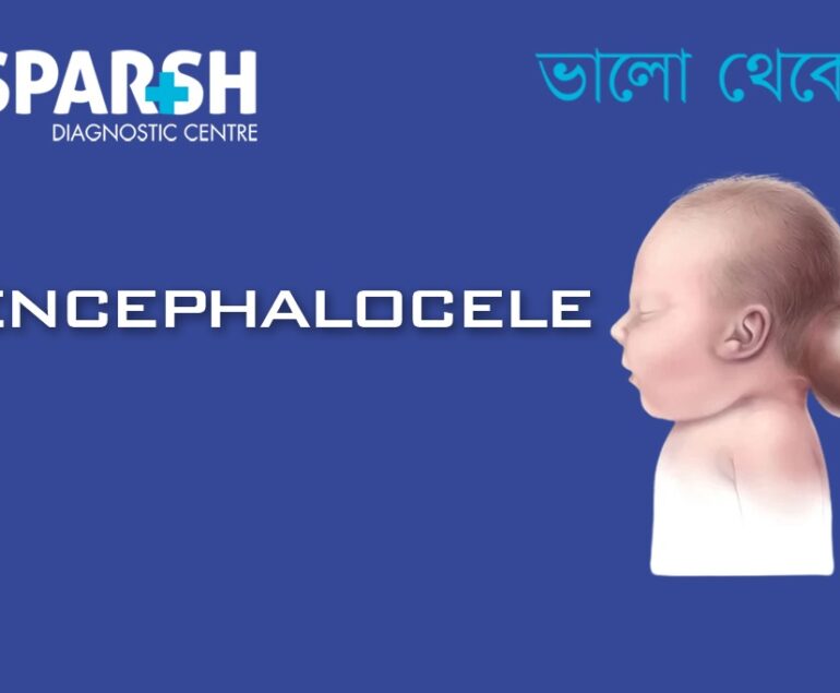 Encephalocele CP