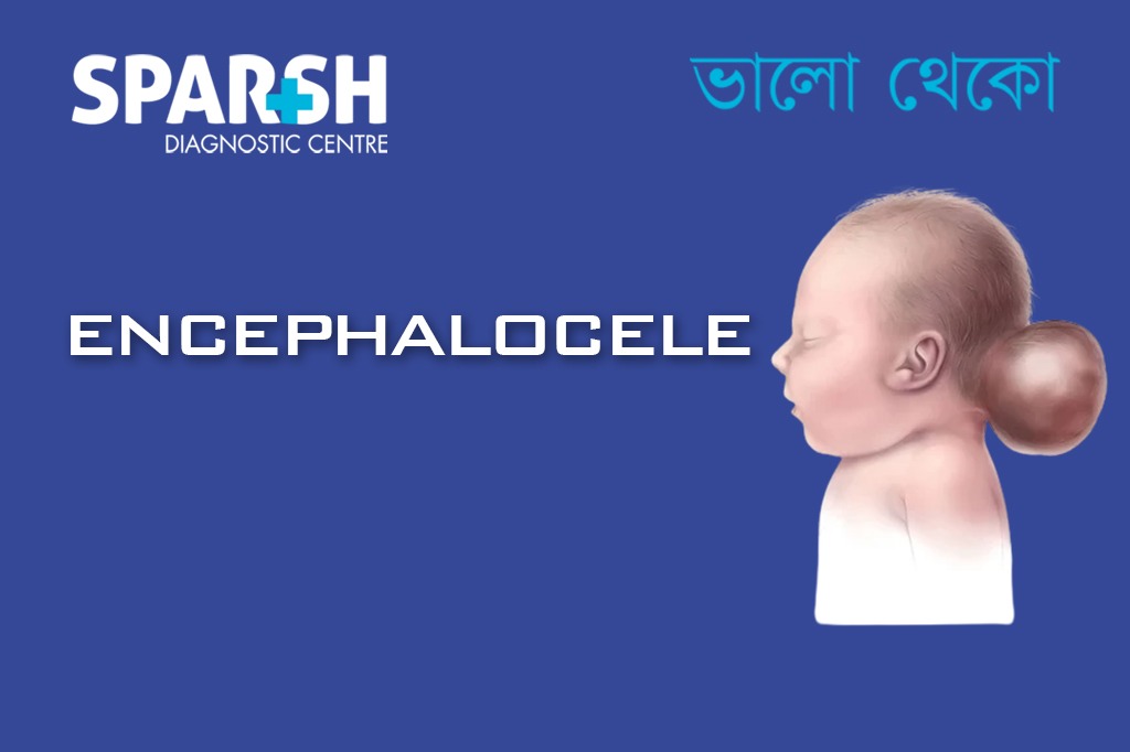 Encephalocele CP