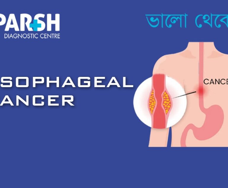 Esophageal Cancer
