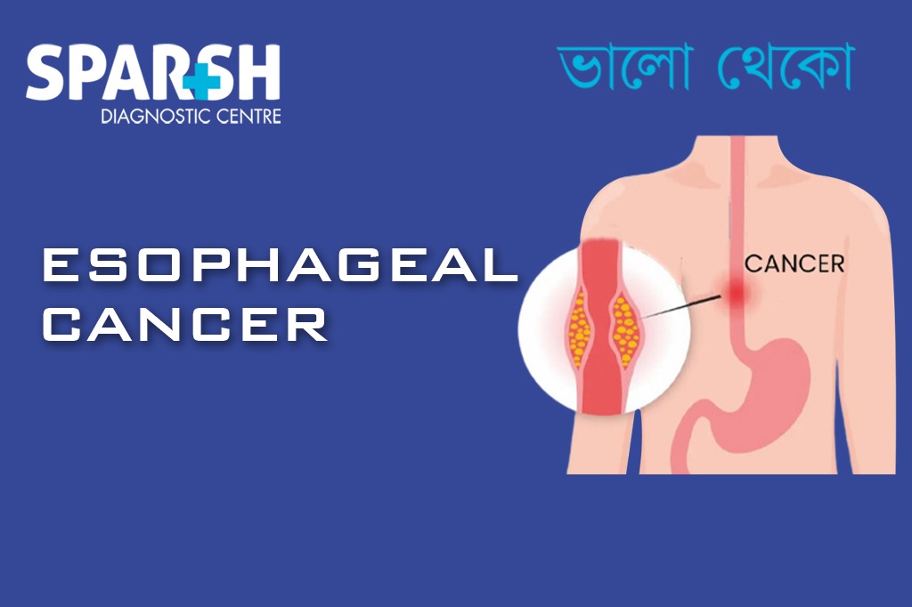 Esophageal Cancer