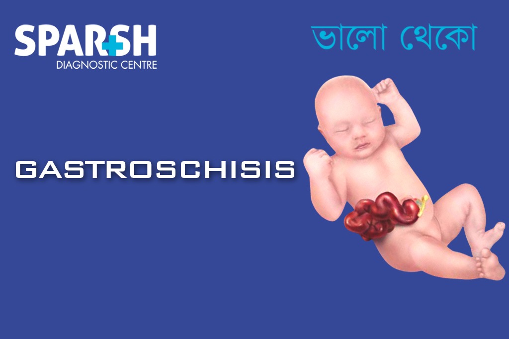 Gastroschisis